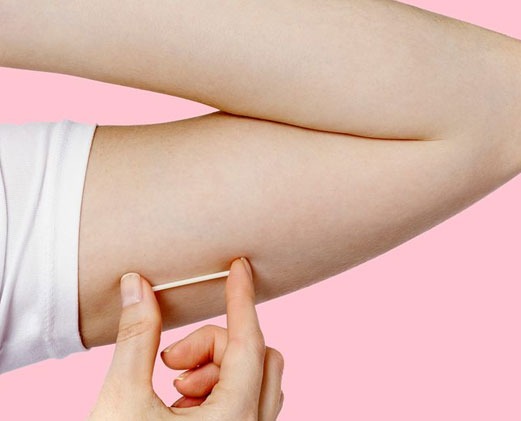 Caruaru Amplia Oferta de Saúde com Implante Anticoncepcional Subdérmico Caruaru Amplia Oferta de Saúde com Implante Anticoncepcional Subdérmico